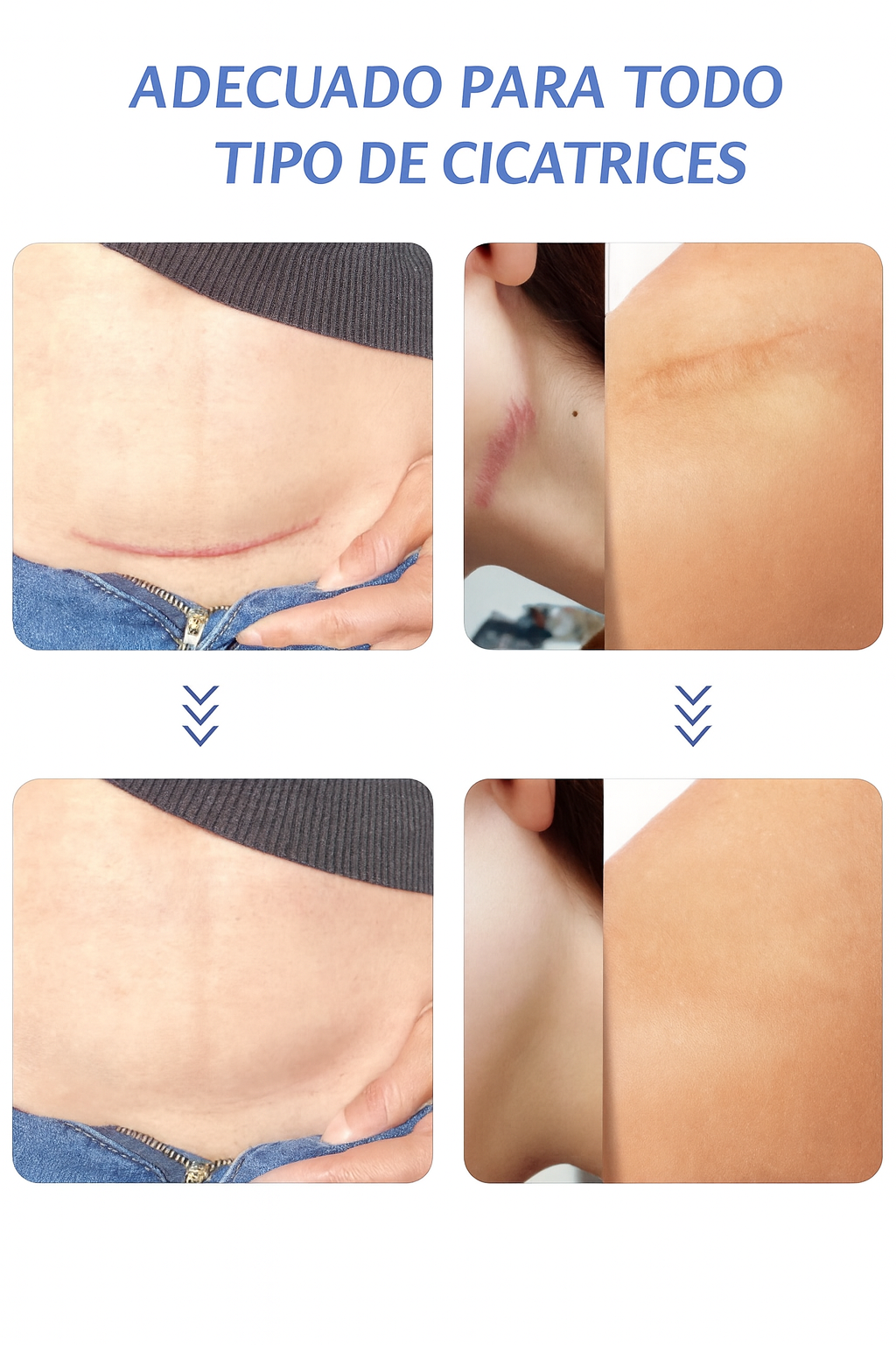 Cinta De Silicona Cicatrices Cirugías Quemaduras Acné